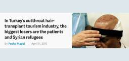 Reportagem denuncia perigosa indústria turca de transplante capilar