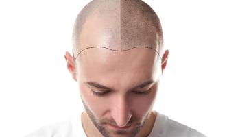 Micropigmentação Capilar ou Tricopigmentação