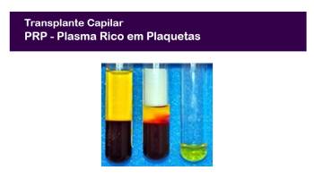 PRP no Implante Capilar