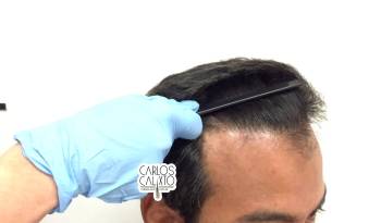 Implante Capilar - Dr Calixto Linha frontal natural