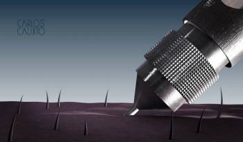 Transplante Capilar - Extração de Unidade Folicular no implante de cabelo, com aparelho automático, computadorizado e robótico - PCID