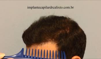 Transplante de Cabelo - Padrão da qualidade de cicatriz em uma cirurgia mista FUT e FUE, no implante capilar