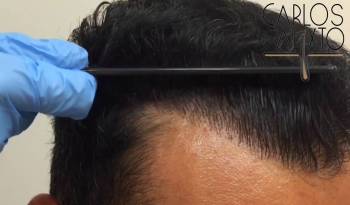 Transplante de Cabelo - Técnica FUE Naturalidade de Resultados