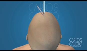 Como é feito o transplante capilar - Técnica FUE?