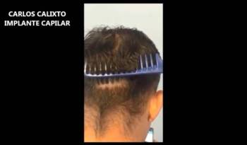 Transplante Capilar - Padrão de qualidade em cicatriz cirurgia mista de Implante de cabelo - FUT e FUE