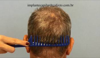 Transplante Capilar - Cicatrização de implante de cabelo utilizando a Técnica Mista - FUT e FUE