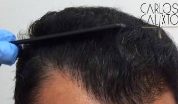 Transplante Capilar - FUE Sem Cicatriz Linear