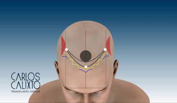  Implante Capilar - Fundamentos da linha anterior no implante de cabelo, naturalidade e volume.