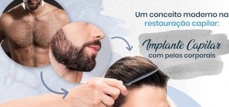 Implante Capilar com pelos corporais - Uma nova tendência no mercado