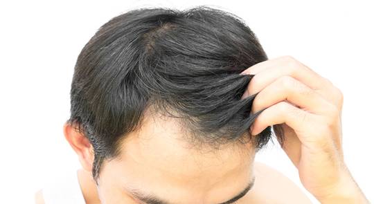 Calvície Masculina