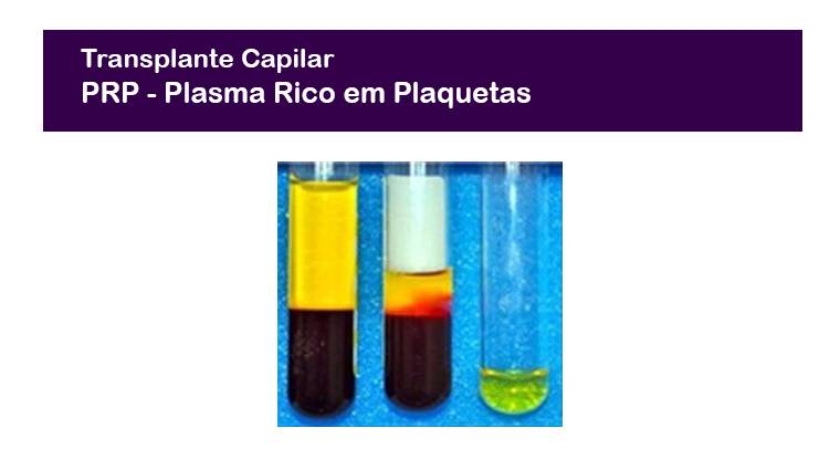 PRP no Implante Capilar